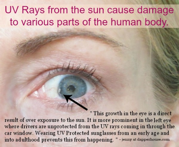UV Rays cause damage to the human body including eye damage as seen here @dapperhouse