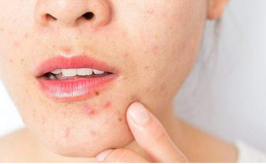 Is CBD Salve Any Good For Acne?